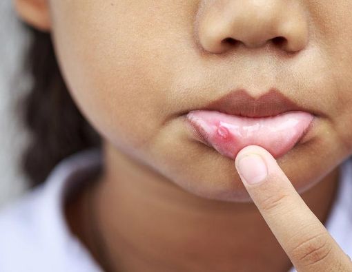 Sariawan Bisa Jadi Gejala HIV, Benarkah?