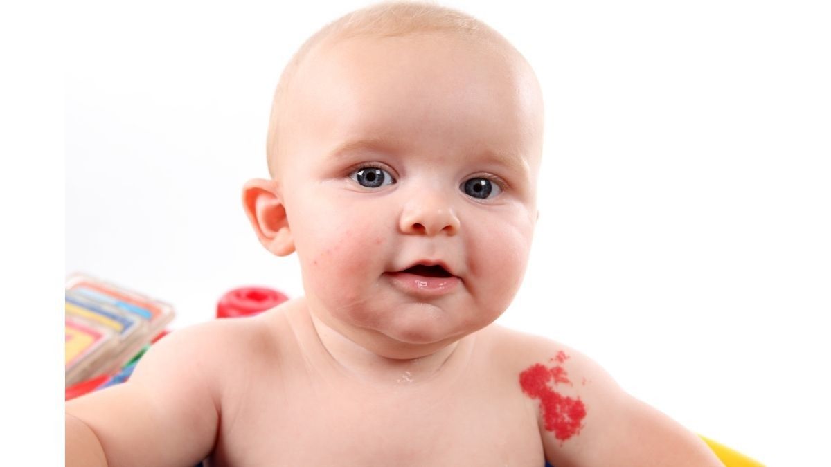 Apakah Tanda Lahir pada Bayi Berbahaya? Cek di Sini