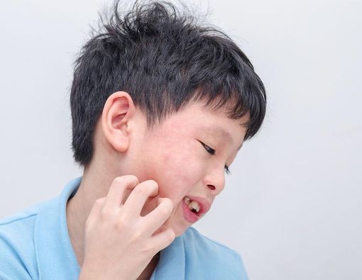 Ciri-ciri Anak Terkena Alergi