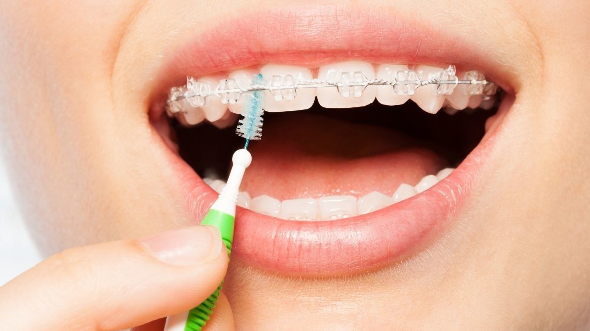 Cara Flossing Gigi yang Benar untuk Pengguna Behel KlikDokter