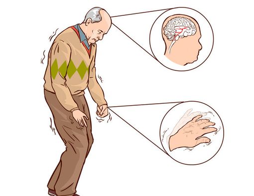 Benarkah Penyakit Parkinson Bermula dari Usus?