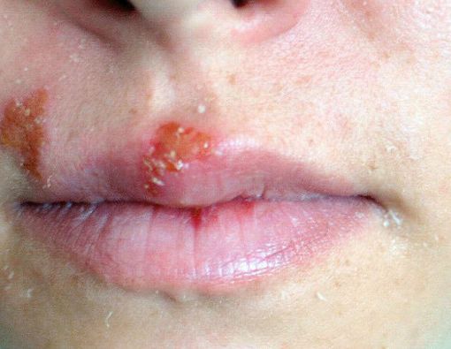 Herpes Labialis, Apa Pemicu dan Bagaimana Penularannya?