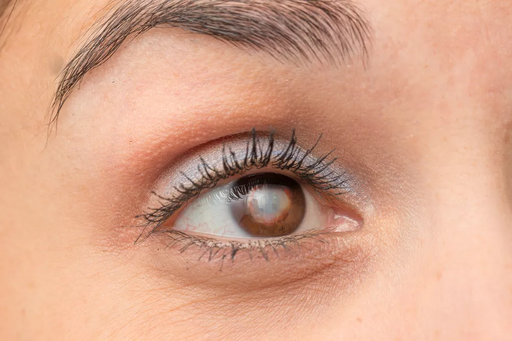 Benarkah Pandangan Mata Berkabut Pertanda Katarak? (sruilk/Shutterstock)