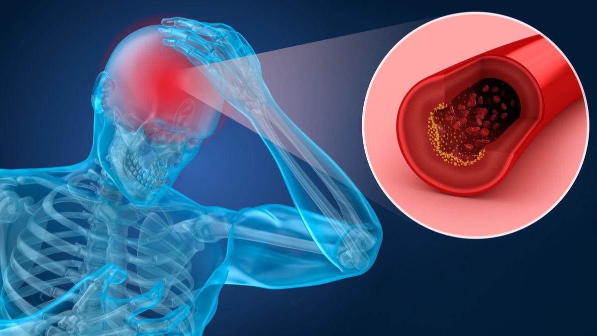 Cara Mengatasi Hilang Ingatan bagi Penderita Stroke
