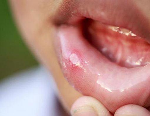 Pentingnya Memperhatikan Asupan Makanan Ketika Sariawan