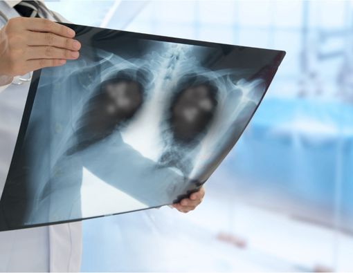 Kenali Pneumonia dan Cara Mencegahnya