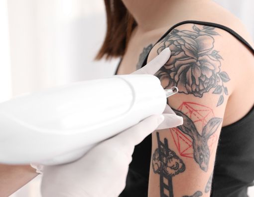 Cara Menghilangkan Tato dengan Laser dan Efek Sampingnya