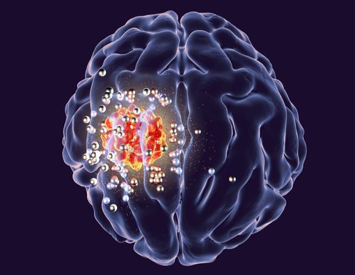 Harapan Hidup Penderita Kanker Otak