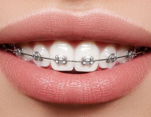 Kawat Gigi Keramik vs Stainless Steel, Mana yang Lebih Baik?