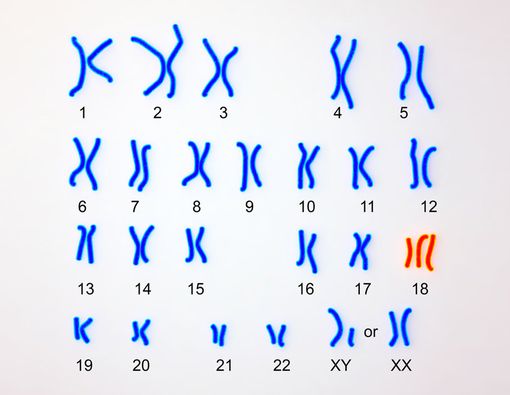 Mengenal Edwards Syndrome Lebih Jauh