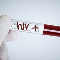Hasil Tes HIV Reaktif (Positif), Ini 10 Hal yang Harus Kamu Lakukan