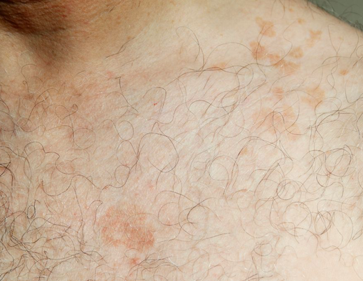 Cari Tahu Penyebab dan Pengobatan Panu Hitam di Kulit