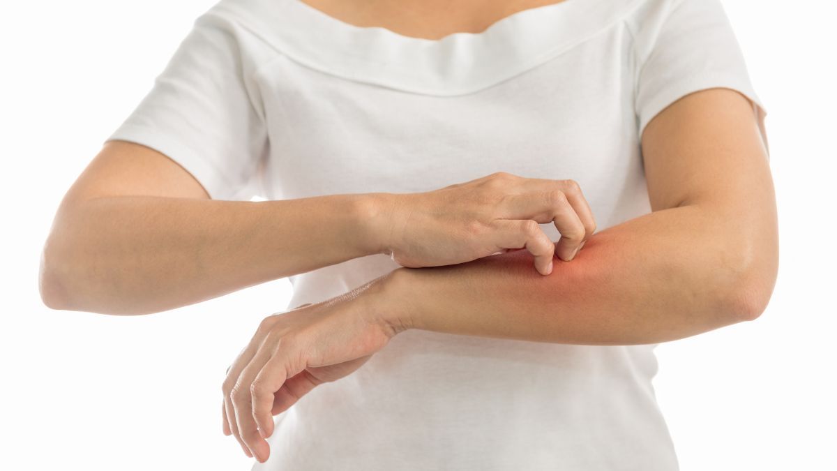 7 Pilihan Obat Paling Ampuh untuk Mengatasi Biduran