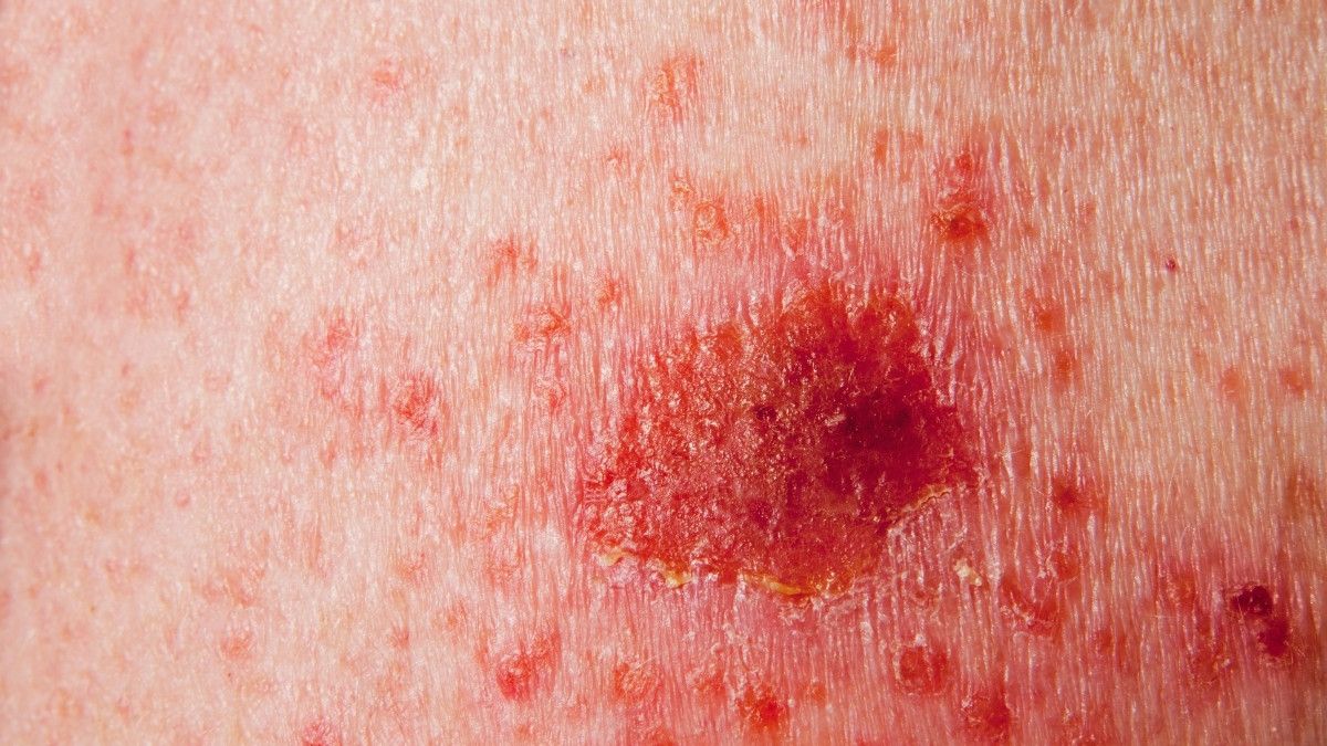 Inilah Perbedaan Kanker Karsinoma dan Sarkoma