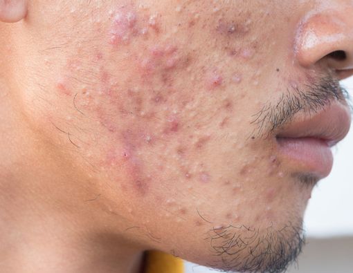 6 Kiat Mengatasi Jerawat Batu pada Wajah