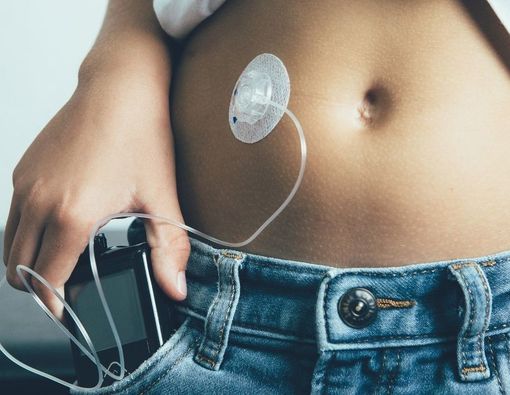 Cara Kerja dan Manfaat Pompa Insulin untuk Penderita Diabetes