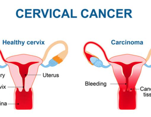 Waspada Kanker Serviks Jika Sering Keputihan Tidak Normal