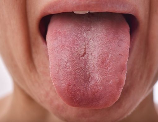 Apakah Fissured Tongue Bisa diobati?