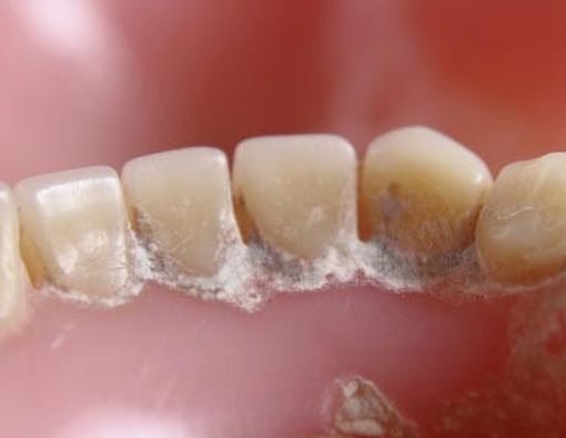 Ini Dia Bahayanya Karang Gigi Jika Dibiarkan!