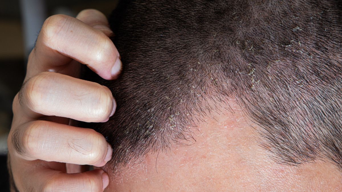 Cara Terbaik Mengatasi Dermatitis Seboroik