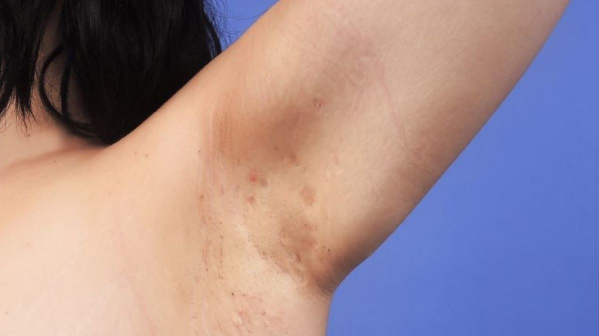 Mengenal Tahapan Penyakit Hidradenitis Suppurativa
