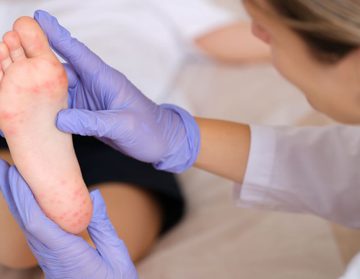 Perbedaan Ruam Cacar Monyet dengan Ruam Biasa