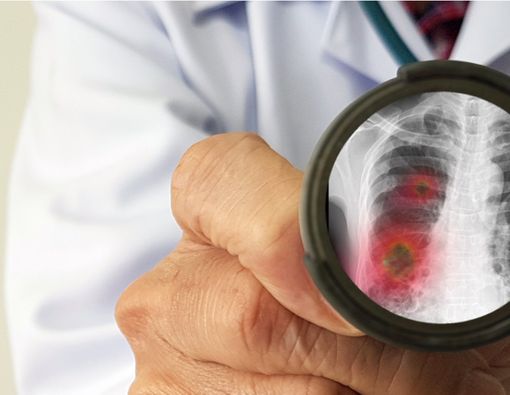 Mayoritas Pasien Positif Virus Corona Mengalami Pneumatosis, Apa Itu?