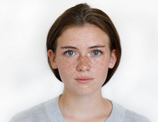 Trik Merawat Kulit Wajah yang Dipenuhi Freckles