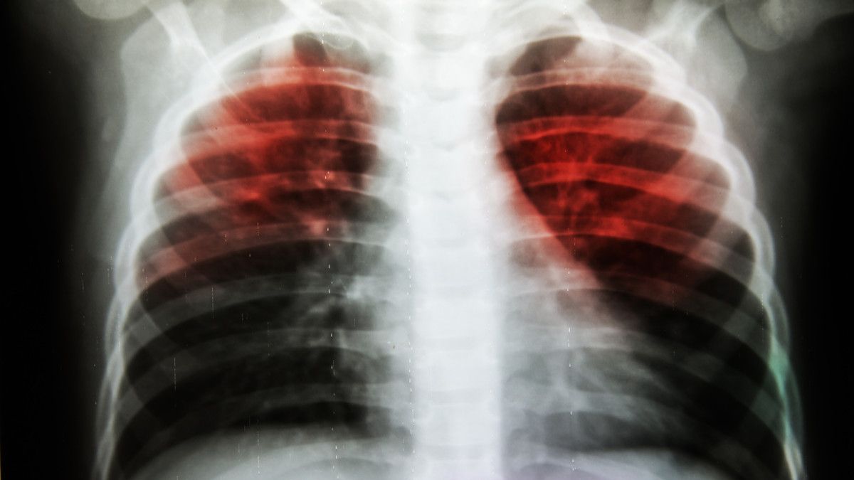 Waspadai Bahaya Penularan TB Paru!