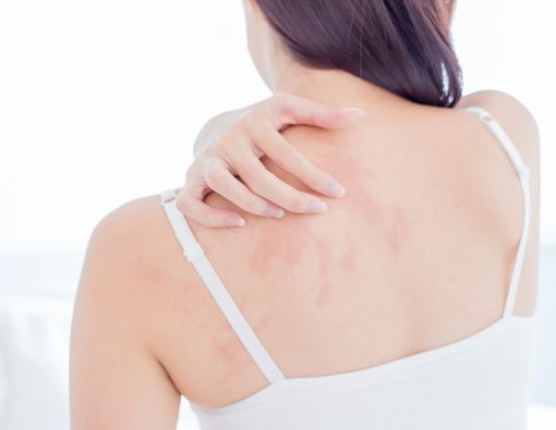 Cara Mengatasi Bekas Gatal Menghitam karena Digaruk