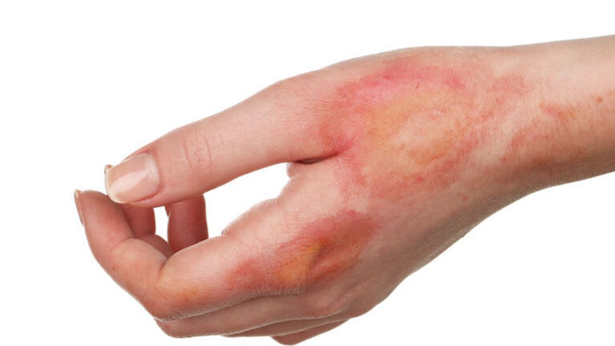 Sangat Langka, Kenali Penyakit Drakula Ini