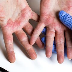 4 Penyebab Telapak Tangan Gatal dan Muncul Bintik Berair