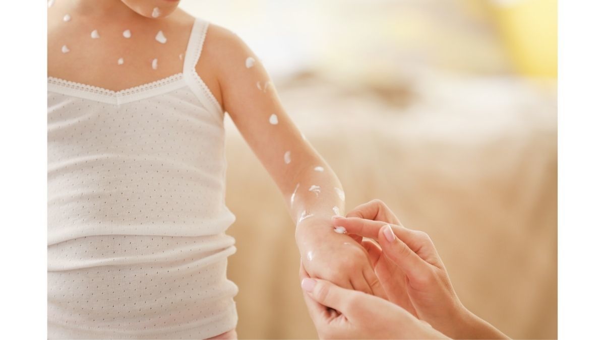 Kiat Efektif Mengobati Cacar Air pada Anak