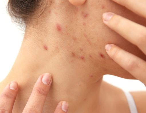 Mitos-Mitos soal Kudis yang Tak Perlu Anda Percayai