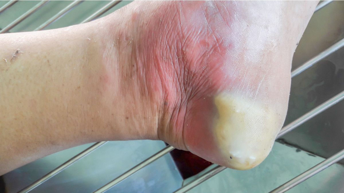 Kaki Diabetes, Komplikasi Diabetes yang Sering Terlupakan