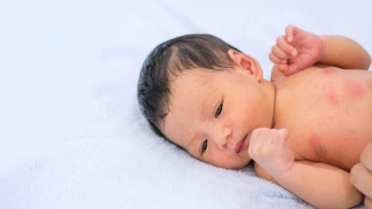 Cara Tepat Mencegah dan Mengatasi Biang Keringat pada Anak 