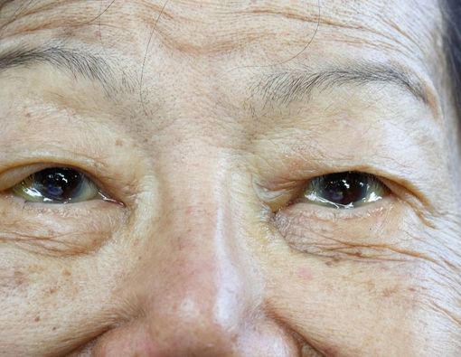 Edema Makula Diabetik, Gangguan Mata pada Penderita Diabetes