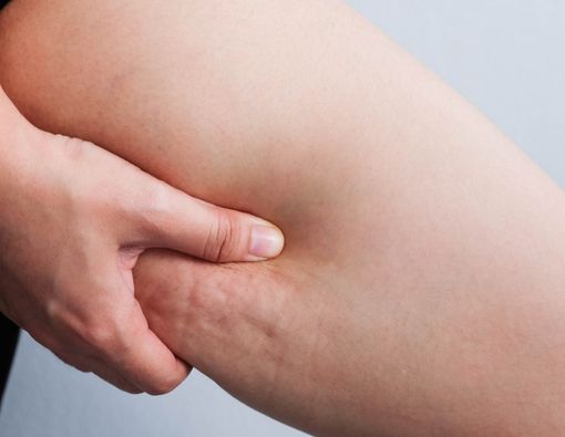 Apa Saja Penyebab Timbulnya Selulit?