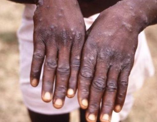 Cacar Monyet atau Flu Babi Afrika yang Lebih Berbahaya?