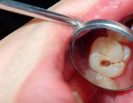 Inilah Berbagai Alasan Gigi Harus Dicabut