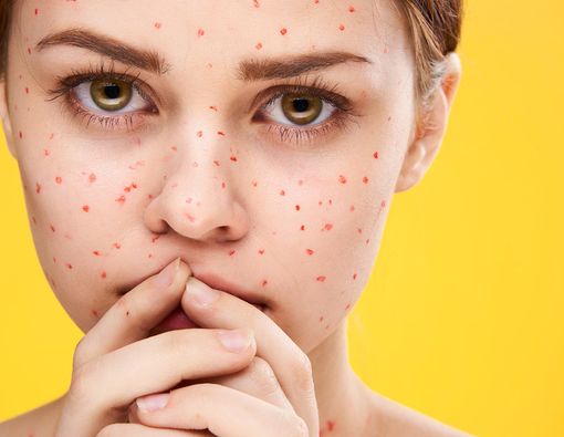 7 Fakta tentang Cacar Air yang Anda Harus Tahu