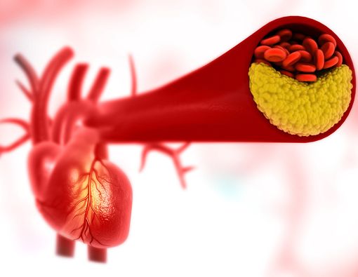 5 Makanan untuk Menghindari Penyumbatan Arteri