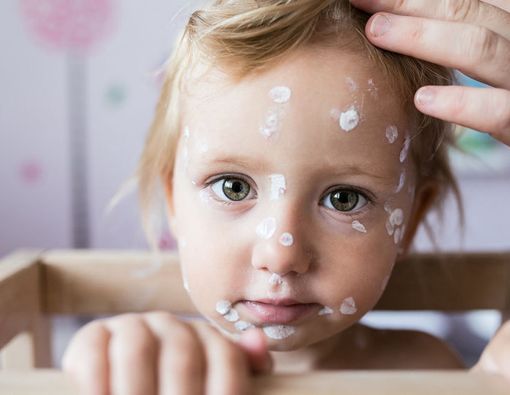 Kiat Atasi Cacar Air agar Sembuh Tanpa Bekas Luka