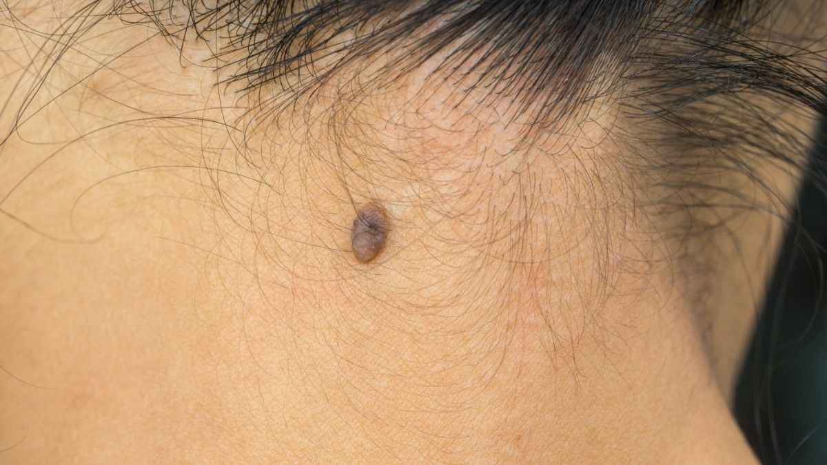 Ternyata Ini Fungsi Tahi Lalat di Tubuh