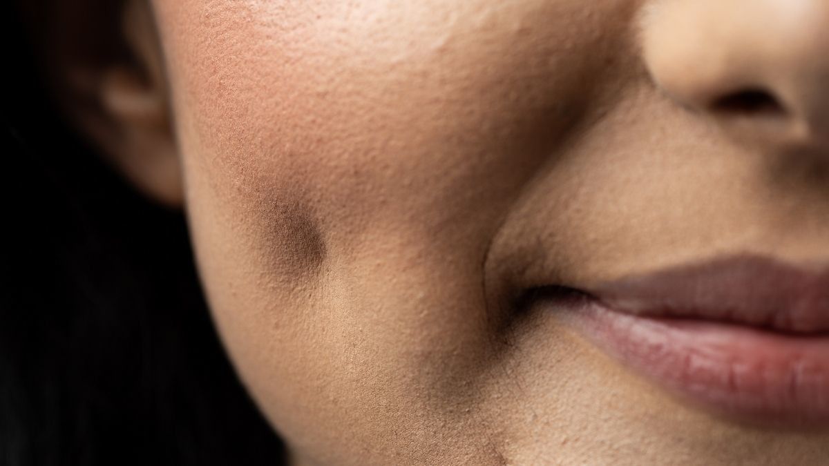 Mengenal Berbagai Jenis Lesung Pipi Manusia