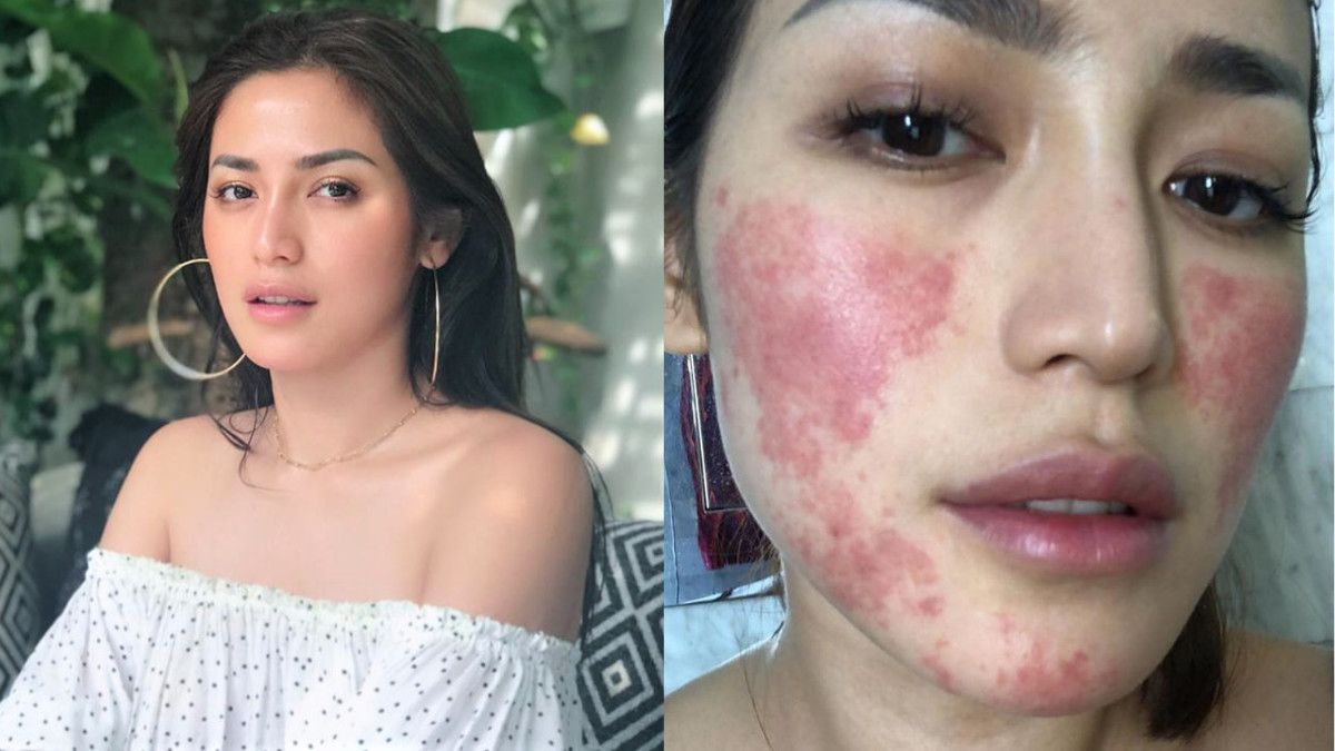 Kenali Alergi Anestesi di Wajah Jessica Iskandar