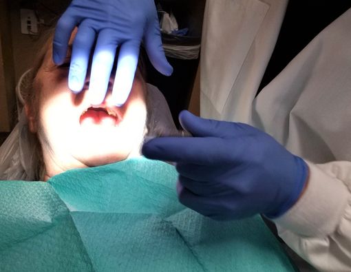 Mengenal Oral Myiasis, Infeksi Belatung di Dalam Mulut