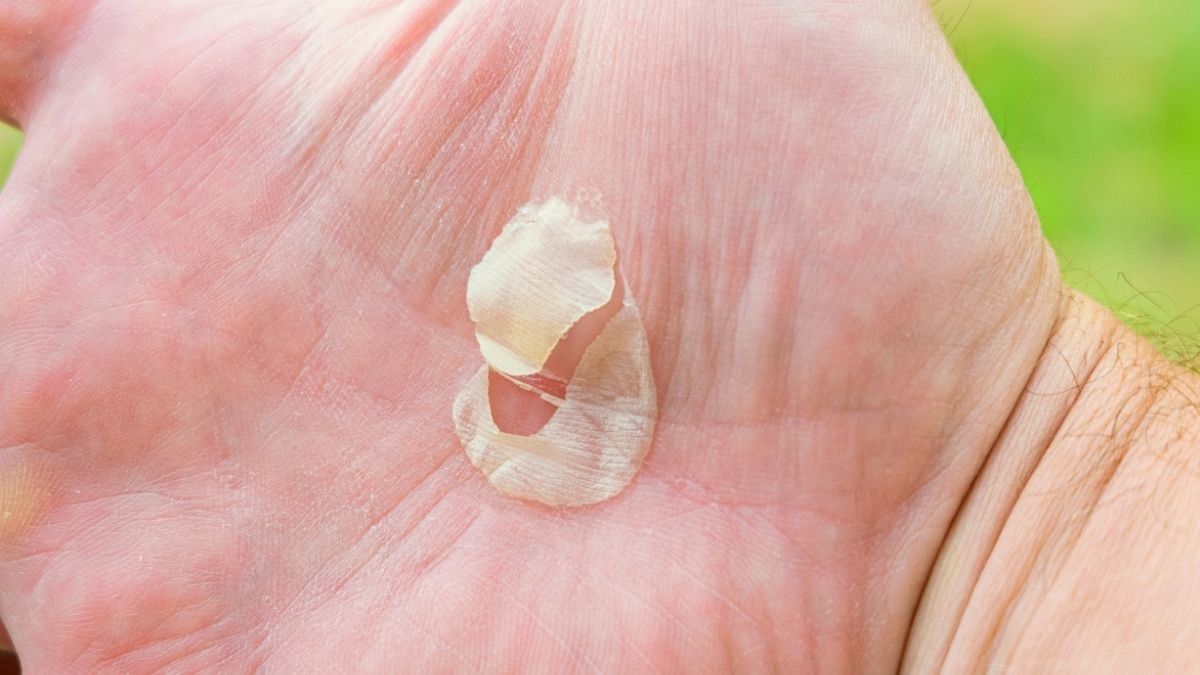 Penyebab Kulit Telapak Tangan Mengelupas dan Cara Atasinya