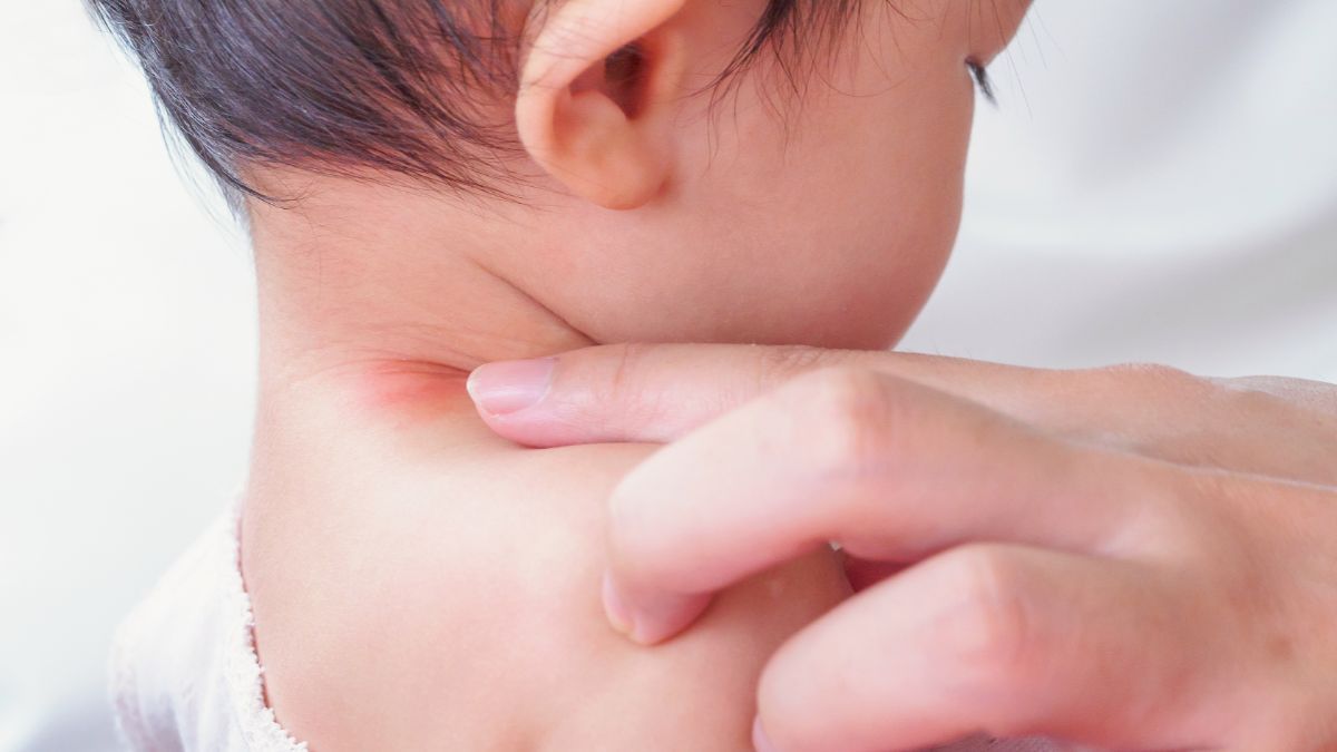 Panu pada Anak, Pahami Gejala, Penyebab, dan Cara Mengobatinya