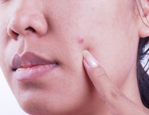 Penyebab Jerawat Kistik dan Cara Mengatasinya